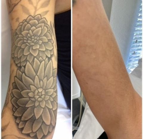PERMANENT TATTOO REMOVAL CREAM +27799196969 ZAMBIA, KENYA, GHANA, NIGERIA, TOGO