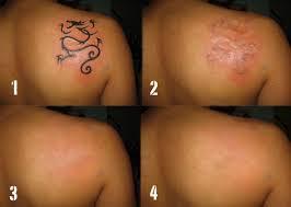 Tattoo remover cream in Cape Town 0027 81 850 2816
